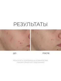 Shineless Oil-Free Moisturizer – Увлажняющий крем для проблемной кожи
